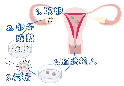 第三代试管婴儿 PGT